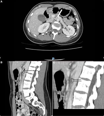 Nutcracker syndrome: A case report and review of the literature